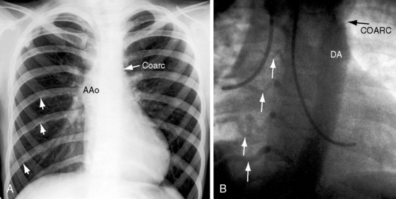 Coarctation Of The Aorta And Interrupted Aortic Arch Clinical Gate