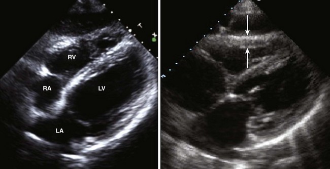 echocardiography-in-the-patient-with-right-heart-failure-clinical-gate