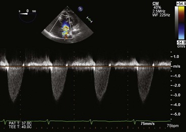 Transesophageal Echocardiogram - Trinity Medical, WNY