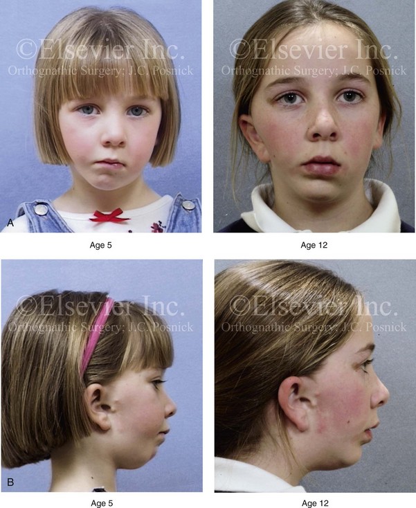 Hemifacial Microsomia Evaluation And Treatment Clinical Gate 6810