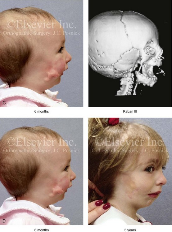 Hemifacial Microsomia Evaluation And Treatment Clinical Gate 9611