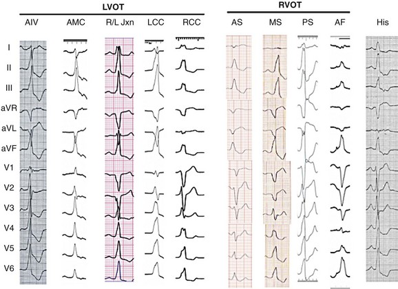 JMC on X: QRS width of a PVC depends on where the PVC came from! Lateral  RV or LV origin results in sequential chamber activation, whereas septal  origin results in simultaneous chamber