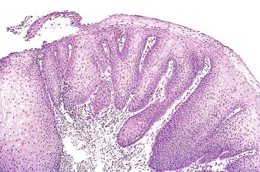 squamous papilloma ge junction)