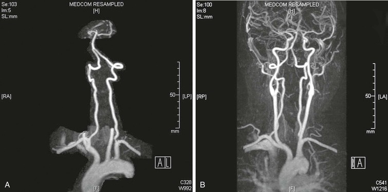 vertebral-artery-stenosis-treatment-quotes-trending-update