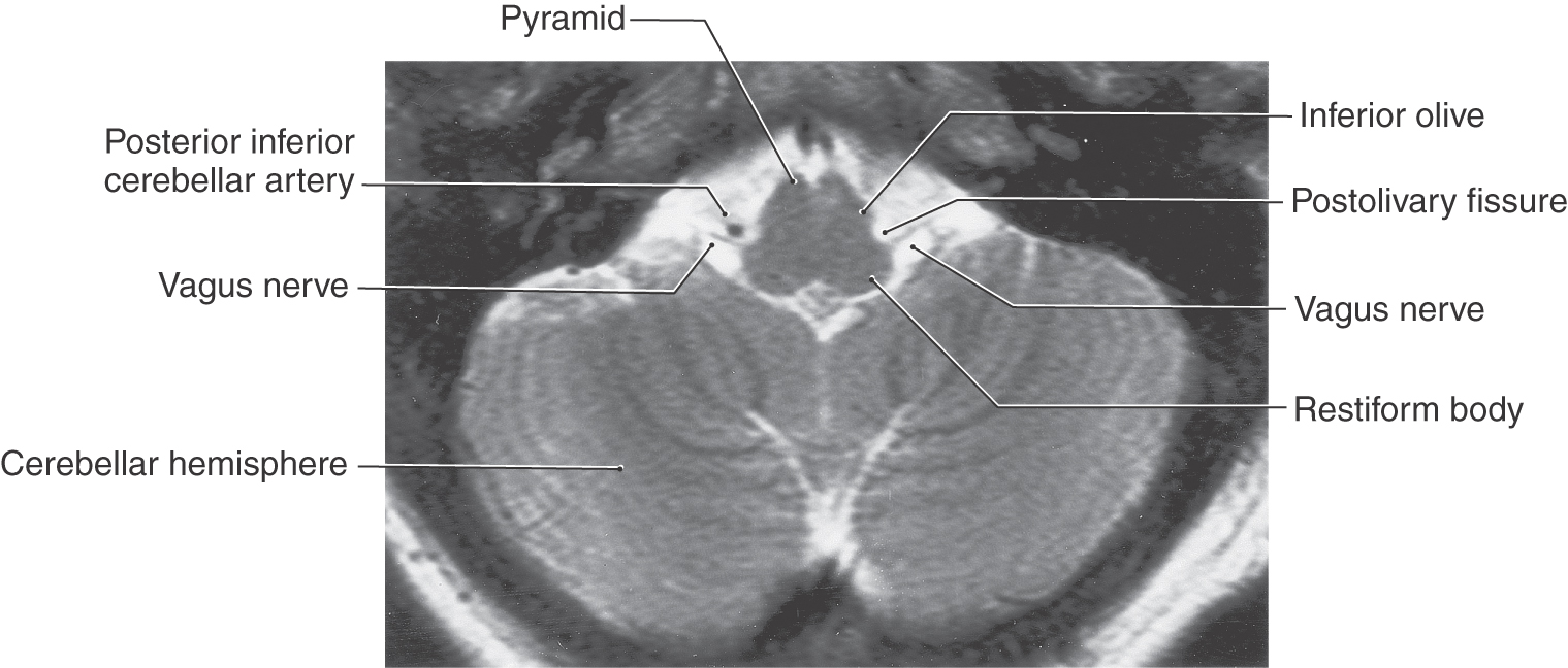 A Synopsis of Cranial Nerves of the Brainstem | Clinical Gate