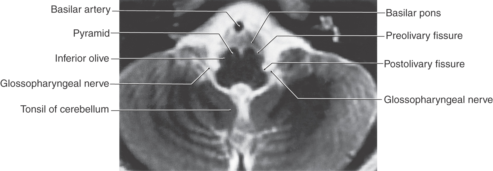 A Synopsis of Cranial Nerves of the Brainstem | Clinical Gate