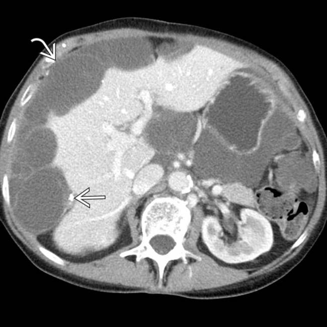 Pseudomyxoma Peritonei Clinical Gate