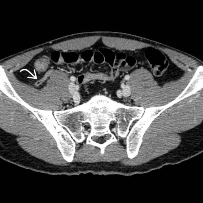 mesenteric-adenitis-and-enteritis-clinical-gate