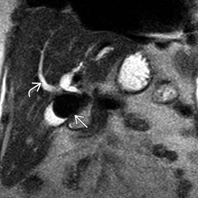 Mirizzi Syndrome Clinical Gate