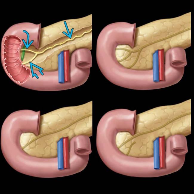 Pancreas Divisum Clinical Gate Pancreas Divisum Clinical Gate