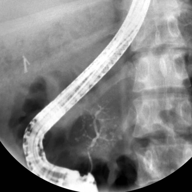 Pancreas Divisum | Clinical Gate